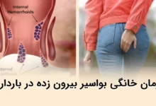 درمان خانگی بواسیر بیرون زده در بارداری